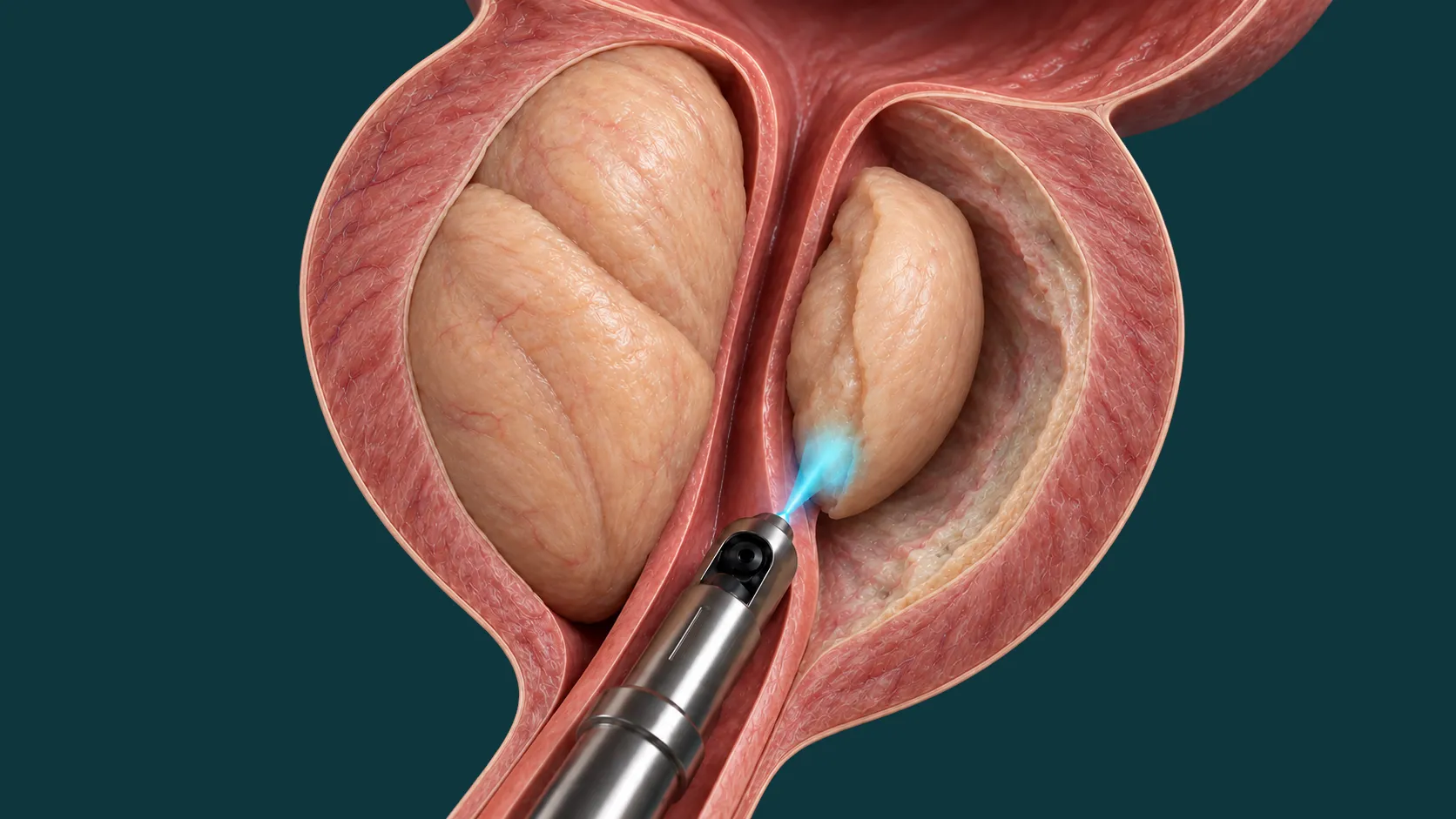 Ilustração tridimensional da técnica HoLEP.