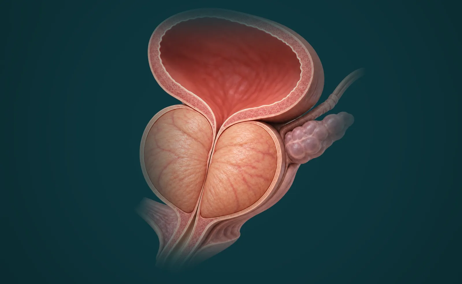 Ilustração da bexiga e da próstata com o canal da uretra comprimido pelo crescimento prostático.