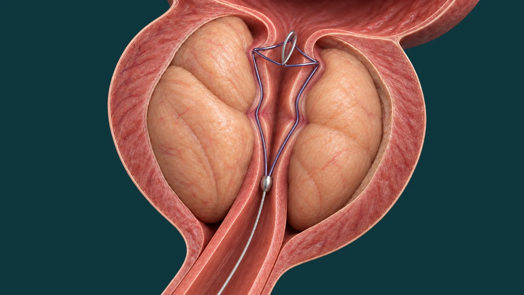 Ilustração tridimensional da técnica iTind.