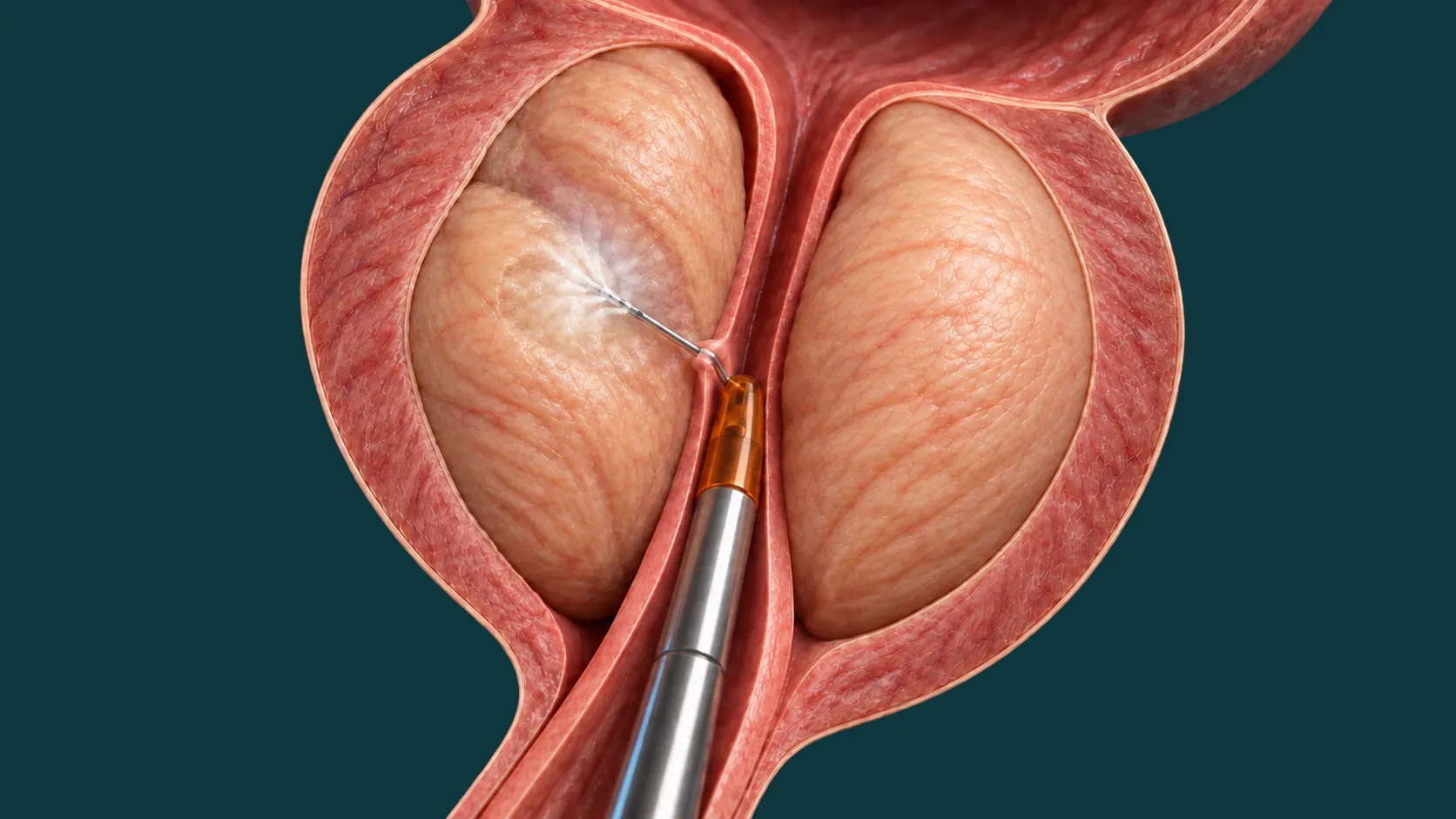 Ilustração tridimensional da técnica Rezum.