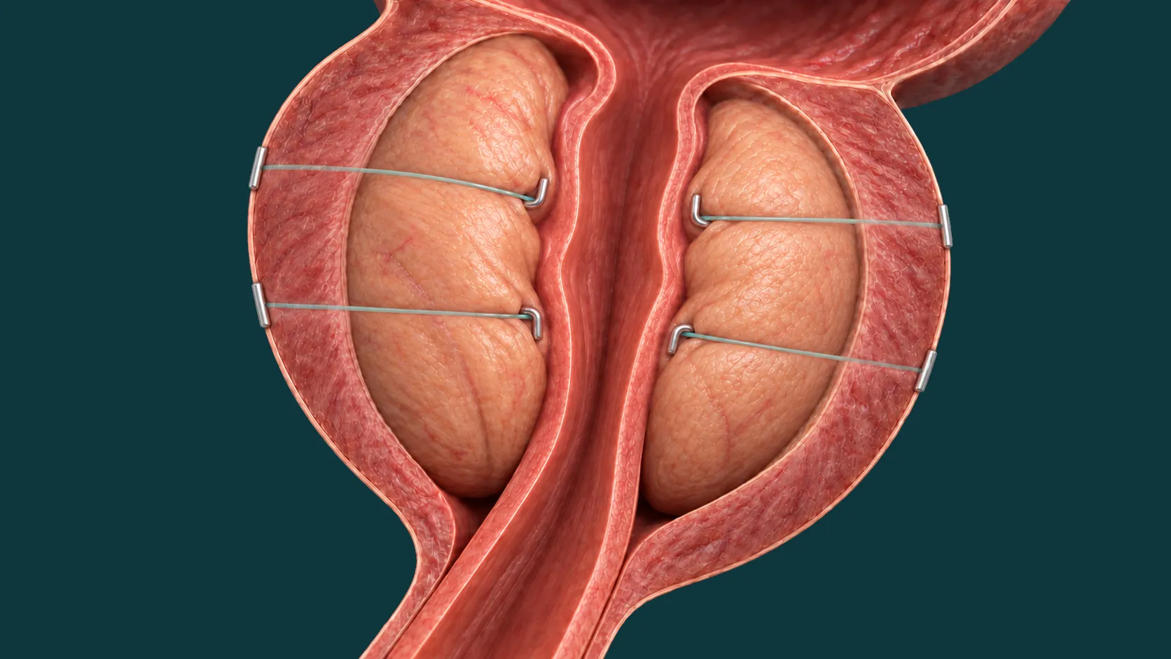 Ilustração tridimensional da técnica Urolift, com quatro implantes afastando os lobos da próstata e o canal urinário aberto entre eles.